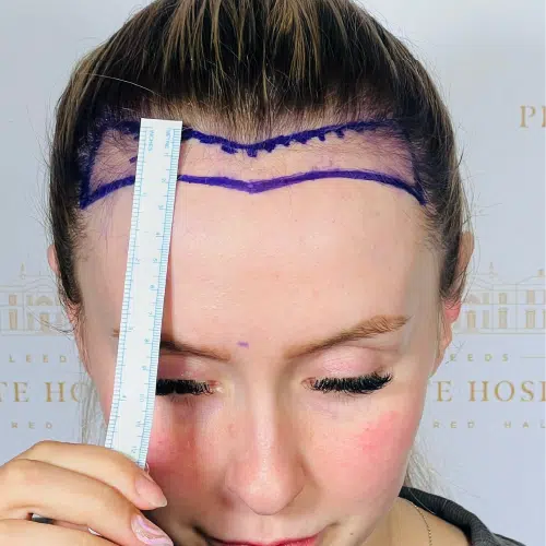 Forehead Reduction 1