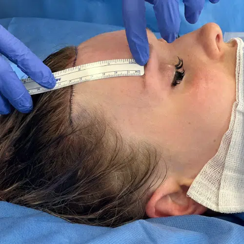 Forehead Reduction 2