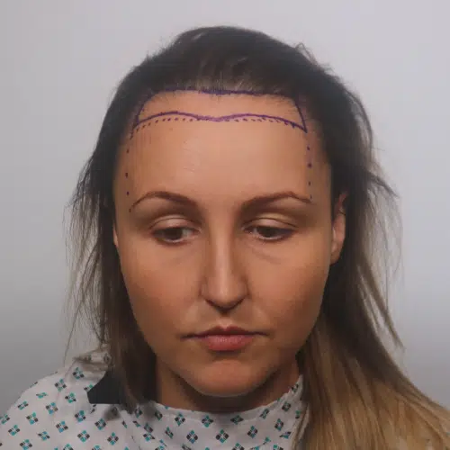 Forehead Reduction 3
