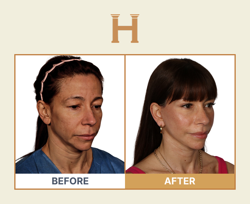 Deep plane face and neck lift before and after result 1 — Leeds Private Hospital