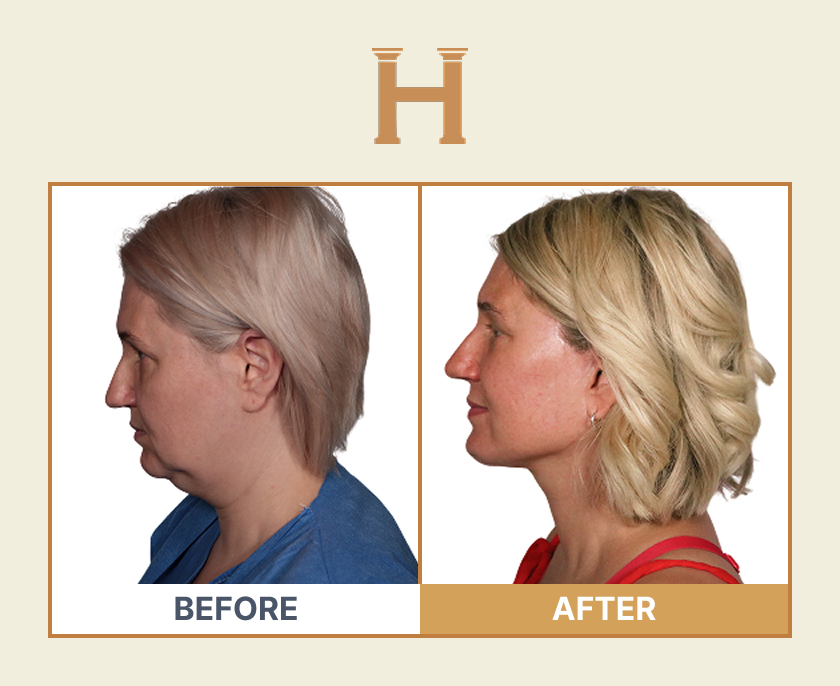 Deep plane face and neck lift before and after result 2 — Leeds Private Hospital