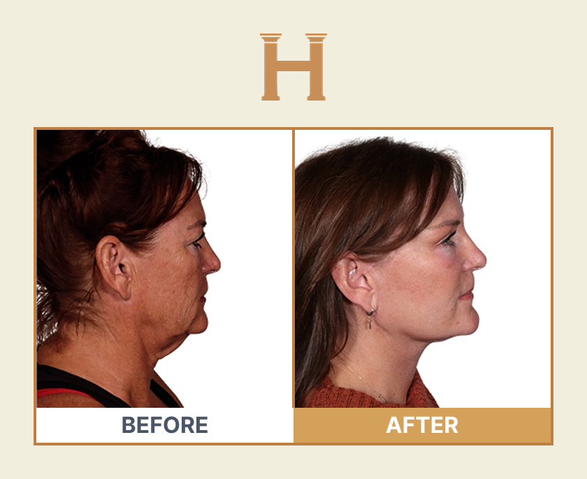 Deep plane face and neck lift before and after result 3 — Leeds Private Hospital