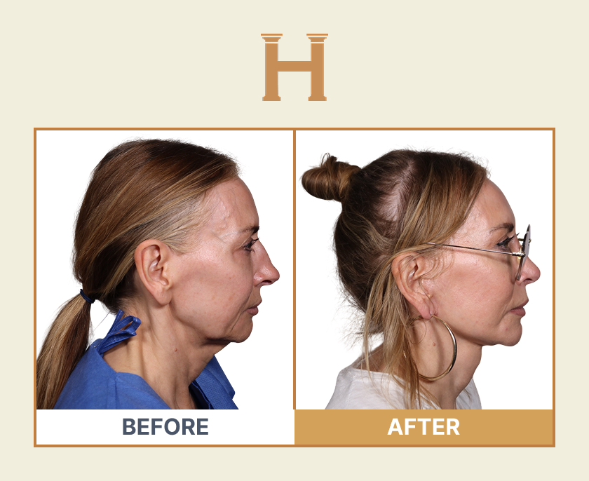 Deep plane face and neck lift before and after result 4 — Leeds Private Hospital