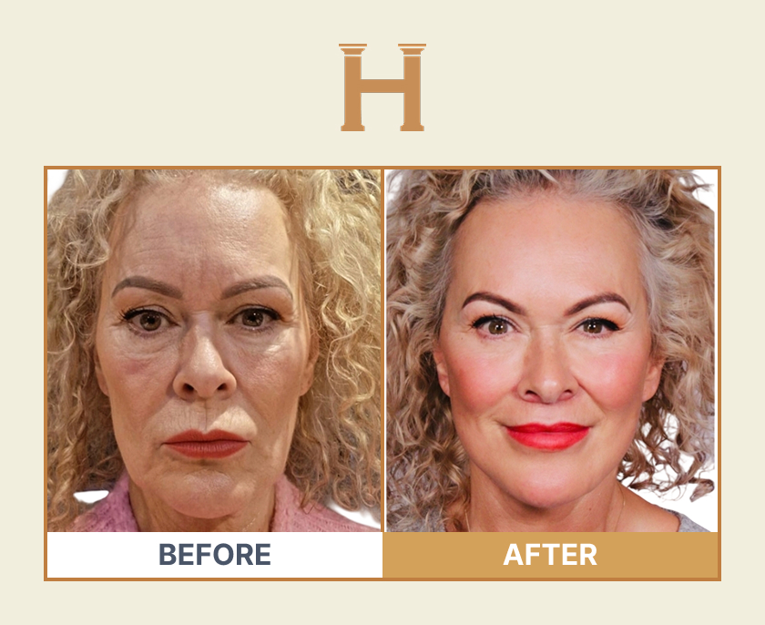 Deep plane face and neck lift before and after result 5 — Leeds Private Hospital