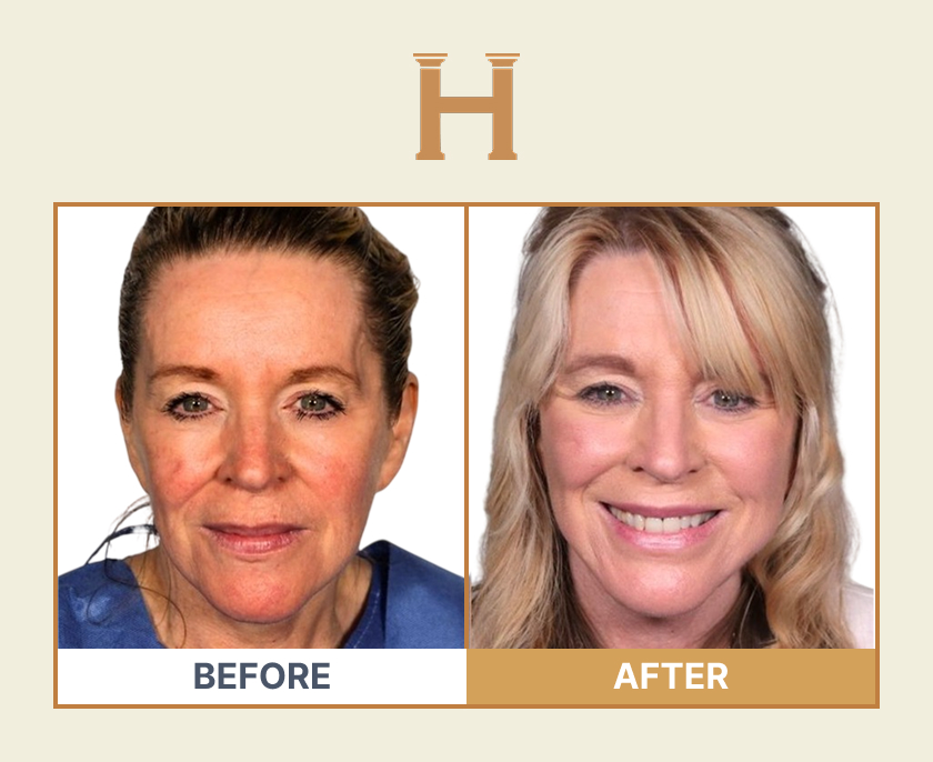 Deep plane face and neck lift before and after result 6 — Leeds Private Hospital