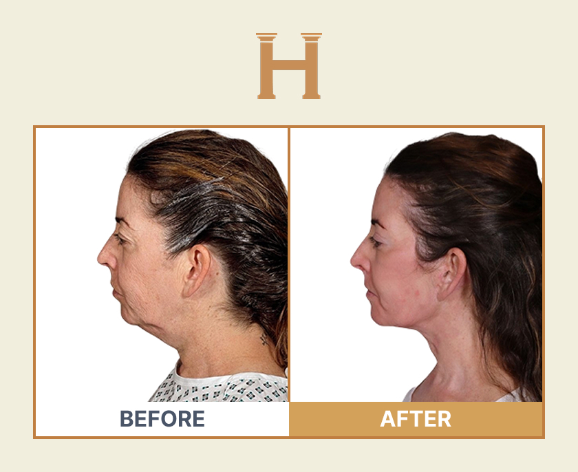 Deep plane face and neck lift before and after result 7 — Leeds Private Hospital