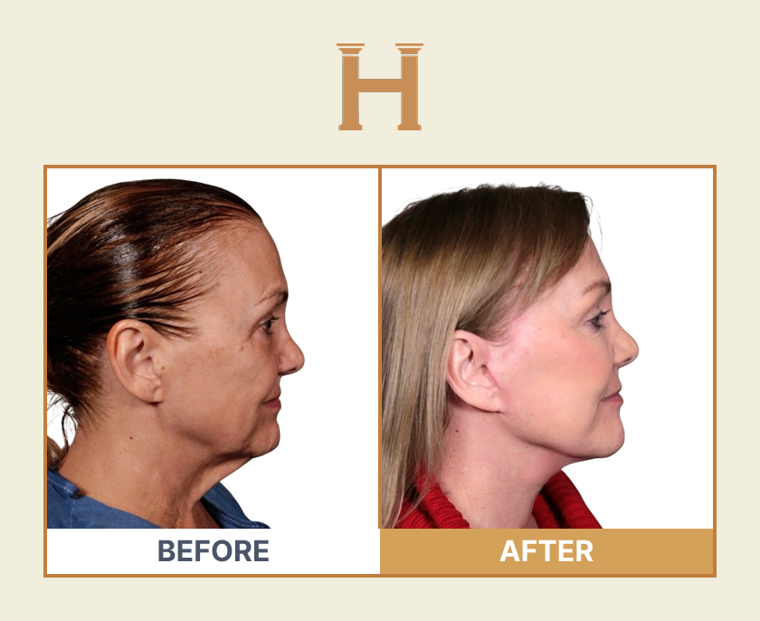 Deep plane face and neck lift before and after result 8 — Leeds Private Hospital