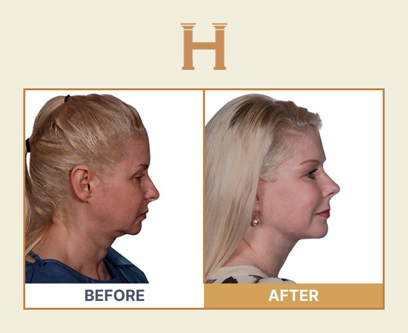 Deep plane face and neck lift before and after result 9 — Leeds Private Hospital