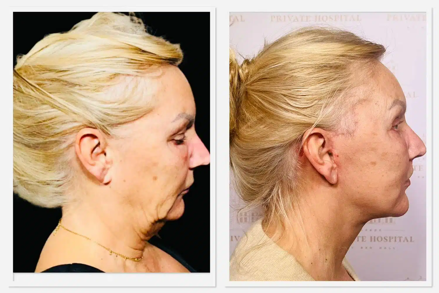 Hydrafacial result 2
