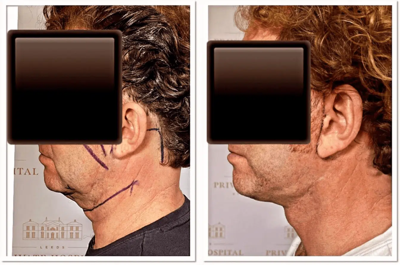 Hydrafacial result 3